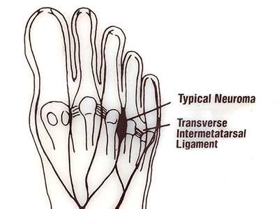 neuroma